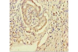 Immunohistochemistry of paraffin-embedded human pancreatic cancer using ABIN7170557 at dilution of 1:100 (SMPD3 抗体  (AA 401-655))