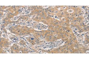 Immunohistochemistry of paraffin-embedded Human gastric cancer using NFE2L1 Polyclonal Antibody at dilution of 1:30 (NFE2L1 抗体)