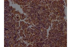 IHC image of ABIN7127384 diluted at 1:100 and staining in paraffin-embedded human lung cancer performed on a Leica BondTM system. (Recombinant Caspase 2 抗体)