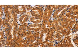 Immunohistochemistry of paraffin-embedded Human thyroid cancer tissue using TNFRSF8 Polyclonal Antibody at dilution 1:60 (TNFRSF8 抗体)