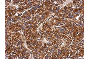 IHC-P Image Immunohistochemical analysis of paraffin-embedded human hepatoma, using MMAB, antibody at 1:500 dilution. (MMAB 抗体  (Center))