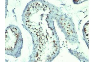 Formalin-fixed, paraffin-embedded human Testicular Carcinoma stained with Nucleolin Monoclonal Antibody (364-5 + NCL/902). (Nucleolin 抗体)