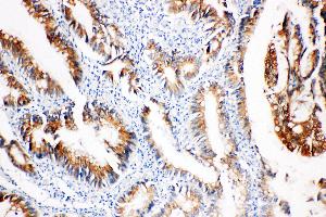 Anti-COX2/Cyclooxygenase 2 antibody, IHC(P) IHC(P): Human Intestinal Cancer Tissue (PTGS2 抗体  (C-Term))