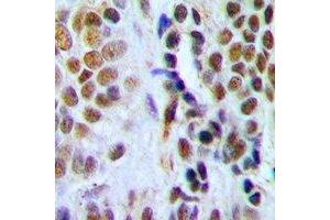 Immunohistochemical analysis of DDB2 staining in human breast cancer formalin fixed paraffin embedded tissue section. (DDB2 抗体)