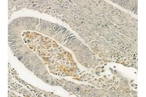 ABIN6259070 and ABIN6274999 at 1/100 staining human colon carcinoma by IHC-P.