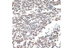 Immunohistochemistry of paraffin-embedded human lung cancer using AQR antibody (ABIN6133411, ABIN6137057, ABIN6137058 and ABIN6221662) at dilution of 1:100 (40x lens). (AQR 抗体  (AA 400-700))