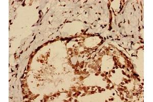 Immunohistochemistry analysis of human breast cancer using ABIN7147553 at dilution of 1:100 (CHID1 抗体  (AA 20-393))