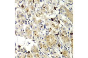 Immunohistochemistry of paraffin-embedded human gastric using MMP9 antibody at dilution of 1:100 (x400 lens). (MMP 9 抗体)