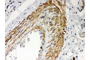 IHC-P: PKC iota antibody testing of human lung cancer tissue (PKC iota 抗体  (AA 21-214))