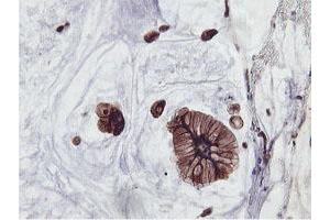 Immunohistochemical staining of paraffin-embedded Adenocarcinoma of Human colon tissue using anti-PFKP mouse monoclonal antibody. (PFKP 抗体)