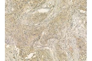 ABIN6262132 and ABIN6276632 at 1/100 staining human cervical carcinoma by IHC-P. (CD236/GYPC 抗体  (Internal Region))