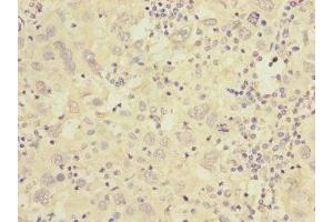 Immunohistochemistry of paraffin-embedded human liver cancer using ABIN7175576 at dilution of 1:100 (CACNG7 抗体  (AA 156-275))