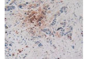 IHC-P analysis of Human Breast Cancer Tissue, with DAB staining. (CPB2 抗体  (AA 138-423))