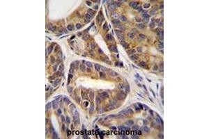 RNF215 Antibody (C-term) immunohistochemistry analysis in formalin fixed and paraffin embedded human prostate carcinoma tissue followed by peroxidase conjugation of the secondary antibody and DAB staining. (RNF215 抗体  (C-Term))
