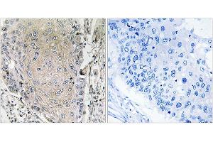 Immunohistochemistry analysis of paraffin-embedded human lung carcinoma tissue using CBLN3 antibody. (CBLN3 抗体)