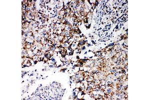 Anti-REA antibody, IHC(P) IHC(P): Human Lung Cancer Tissue (Prohibitin 2 抗体  (Middle Region))