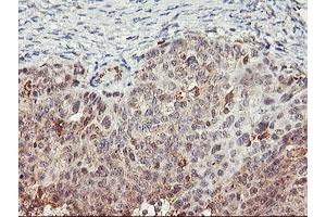 Immunohistochemical staining of paraffin-embedded Adenocarcinoma of Human ovary tissue using anti-TULP3 mouse monoclonal antibody. (TULP3 抗体)