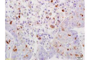Formalin-fixed and paraffin embedded human lung carcinoma labeled with Rabbit Anti-JNK1/2/3 Polyclonal Antibody, Unconjugated (ABIN747713) at 1:200 followed by conjugation to the secondary antibody and DAB staining (JNK 抗体  (AA 151-250))