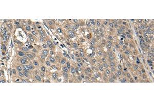 Immunohistochemistry of paraffin-embedded Human liver cancer tissue using FCGR1A Polyclonal Antibody at dilution of 1:35(x200) (FCGR1A 抗体)