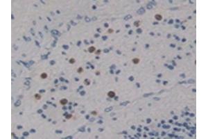 Detection of Ntn4 in Human Lung Cancer Tissue using Polyclonal Antibody to Netrin 4 (Ntn4) (Netrin 4 抗体  (AA 349-592))
