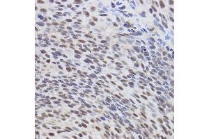 Immunohistochemistry of paraffin-embedded human lung cancer using  Rabbit pAb (ABIN6127378, ABIN6137233, ABIN6137235 and ABIN6217480) at dilution of 1:300 (40x lens).