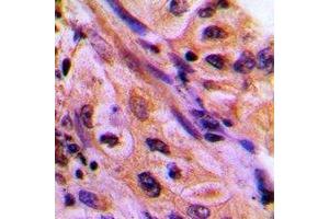Immunohistochemical analysis of CDC42EP4 staining in human lung cancer formalin fixed paraffin embedded tissue section.
