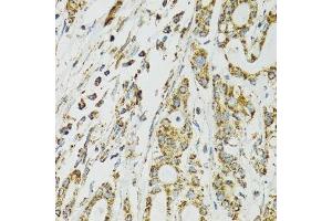 Immunohistochemistry of paraffin-embedded human colon carcinoma using HSPA9 antibody. (HSPA9 抗体  (AA 380-679))