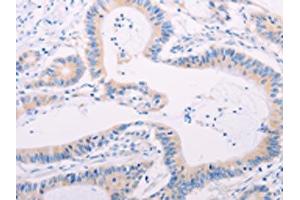 The image on the left is immunohistochemistry of paraffin-embedded Human colon cancer tissue using ABIN7189656(ADAMTS17 Antibody) at dilution 1/60, on the right is treated with synthetic peptide. (ADAMTS17 抗体)