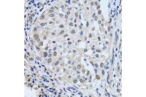 Immunohistochemistry of paraffin-embedded human lung cancer using LSM4 antibody (ABIN1980258) at dilution of 1:100 (40x lens). (LSM4 抗体)