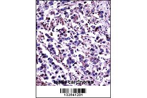 CAPN11 Antibody immunohistochemistry analysis in formalin fixed and paraffin embedded human testis carcinoma followed by peroxidase conjugation of the secondary antibody and DAB staining. (CAPN11 抗体  (AA 409-438))