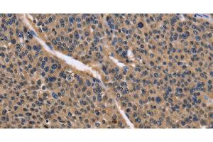 Immunohistochemistry of paraffin-embedded Human liver cancer using IDH1 Polyclonal Antibody at dilution of 1:50 (IDH1 抗体)