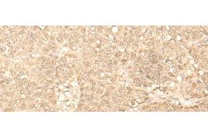 Immunohistochemistry of paraffin-embedded Human ovarian cancer tissue using FAH Polyclonal Antibody at dilution of 1:40(x200) (FAH 抗体)