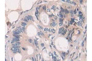 Detection of GHRH in Human Colorectal cancer Tissue using Polyclonal Antibody to Growth Hormone Releasing Hormone (GHRH) (GHRH 抗体  (AA 19-108))