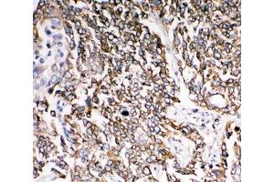 IHC-P: PMP70 antibody testing of human lung cancer tissue