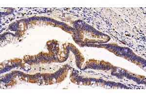 Detection of KRT6A in Human Colorectal cancer Tissue using Polyclonal Antibody to Keratin 6A (KRT6A) (KRT6A 抗体  (AA 163-468))