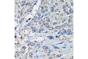 Immunohistochemistry of paraffin-embedded human esophageal cancer using RanG Rabbit pAb (ABIN6128613, ABIN6146681, ABIN6146683 and ABIN6217306) at dilution of 1:50 (40x lens). (RANGAP1 抗体  (AA 398-587))