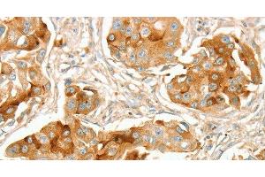 Immunohistochemistry of paraffin-embedded Human breast cancer using ACE1 Polyclonal Antibody at dilution of 1:70 (Angiotensin I Converting Enzyme 1 抗体)