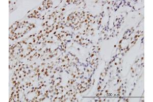 Immunoperoxidase of monoclonal antibody to SYMPK on formalin-fixed paraffin-embedded human ovary, clear cell carcinoma. (Symplekin 抗体  (AA 1-533))