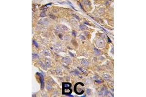 Formalin-fixed and paraffin-embedded human breast carcinoma tissue reacted with EIF4B-, which was peroxidase-conjugated to the secondary antibody, followed by DAB staining. (EIF4B 抗体  (AA 400-429))