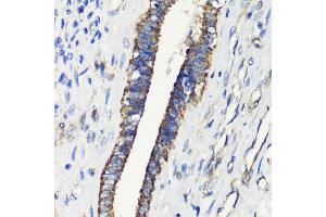Immunohistochemistry of paraffin-embedded human uterine cancer using FKBP12 antibody (ABIN3022503, ABIN3022504, ABIN3022505 and ABIN6218864) at dilution of 1:200 (40x lens).