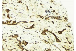 ABIN6269249 at 1/100 staining Human breast cancer tissue by IHC-P. (STAT5A 抗体)