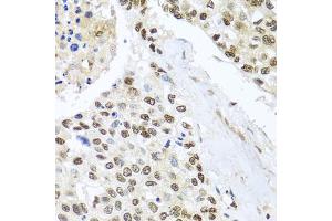 Immunohistochemistry of paraffin-embedded human lung cancer using BNIP3L antibody. (BNIP3L/NIX 抗体)