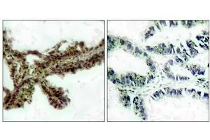 Immunohistochemical analysis of paraffin-embedded human lung carcinoma tissue, using Akt (phospho-Thr308) antibody(E011055). (AKT1 抗体  (pThr308))