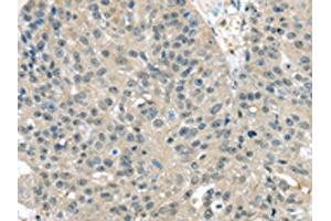 The image on the left is immunohistochemistry of paraffin-embedded Human breast cancer tissue using ABIN7128053(TXNDC17 Antibody) at dilution 1/30, on the right is treated with fusion protein.