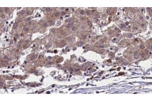ABIN6273958 at 1/100 staining Human liver cancer tissue by IHC-P. (OR51L1 抗体  (Internal Region))