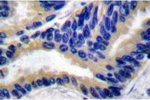 Immunohistochemistry analyzes of Actived-Caspase-3 p17 Antibody in paraffin-embedded human lung carcinoma tissue. (Caspase 3 抗体)