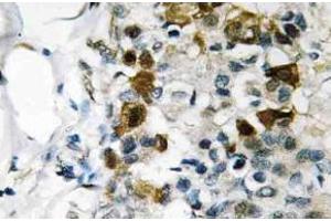 Immunohistochemistry (IHC) analyzes of p-HSP27 antibody in paraffin-embedded human breast carcinoma tissue. (HSP27 抗体  (pSer82))