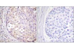 Immunohistochemistry analysis of paraffin-embedded human breast carcinoma tissue, using PKC-pan (Ab-Thr497) Antibody. (PKC 抗体  (Thr497))