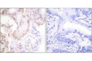 Immunohistochemistry analysis of paraffin-embedded human lung carcinoma tissue, using Cyclin G Antibody. (Cyclin G1 抗体  (AA 161-210))