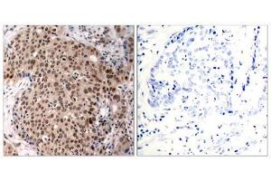Immunohistochemical analysis of paraffin-embedded human breast carcinoma tissue, using MAPKAPK-2 (Phospho-Thr334) antibody (E011308). (MAPKAP Kinase 2 抗体  (pThr334))